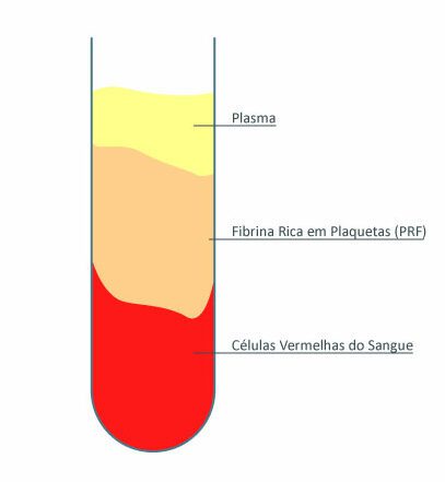 fibrina Esquema de extração