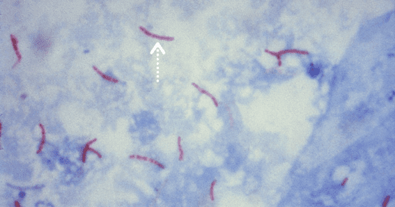 teste de baciloscopia para tuberculose